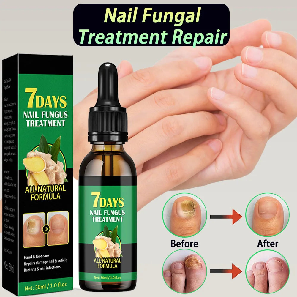 Nail Fungal Treatment Device – 7-Day Repair Gel with Ginger Essence